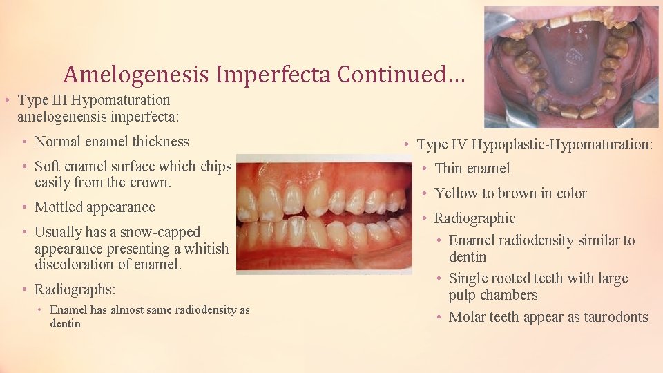Amelogenesis Imperfecta Continued… • Type III Hypomaturation amelogenensis imperfecta: • Normal enamel thickness •