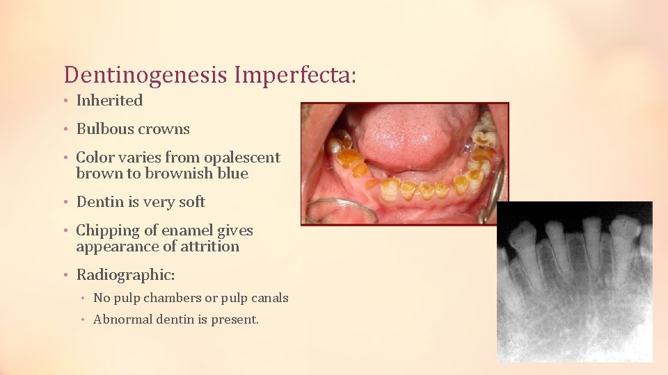 Dentinogenesis Imperfecta: • Inherited • Bulbous crowns • Color varies from opalescent brown to