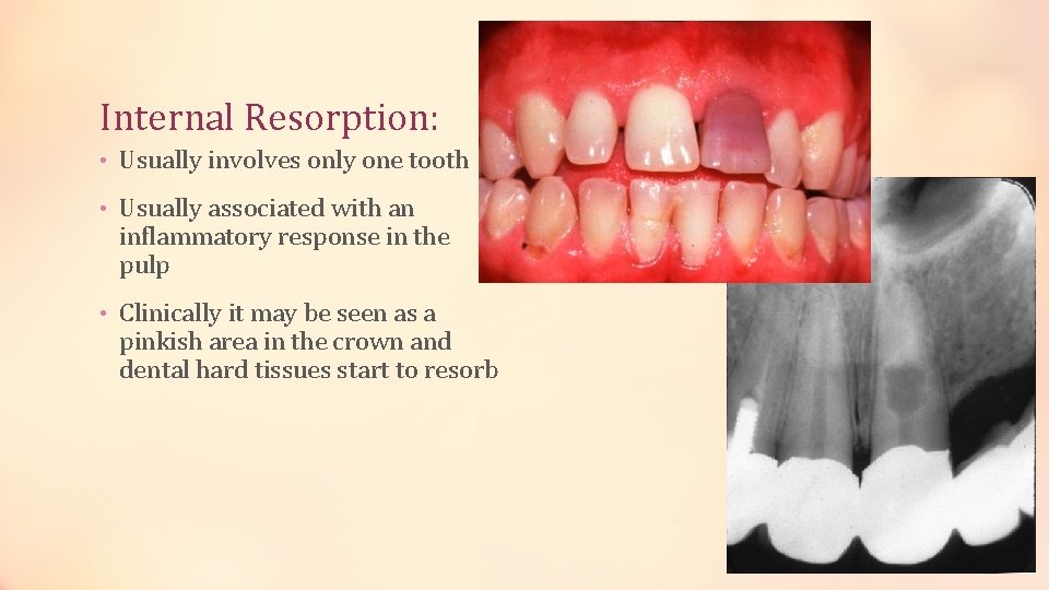 Internal Resorption: • Usually involves only one tooth • Usually associated with an inflammatory