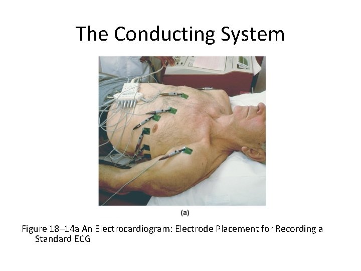 The Conducting System Figure 18– 14 a An Electrocardiogram: Electrode Placement for Recording a