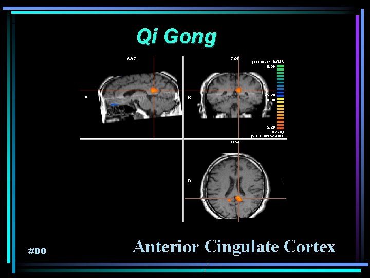 Qi Gong #00 Anterior Cingulate Cortex 