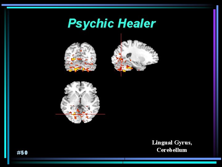 Psychic Healer #50 Lingual Gyrus, Cerebellum 