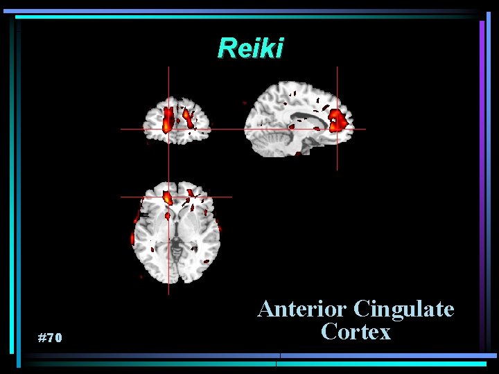 Reiki #70 Anterior Cingulate Cortex 