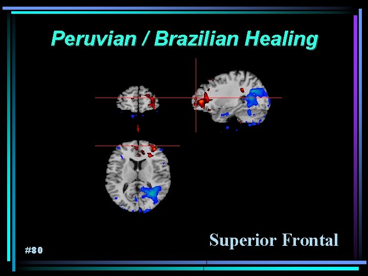 Peruvian / Brazilian Healing #80 Superior Frontal 