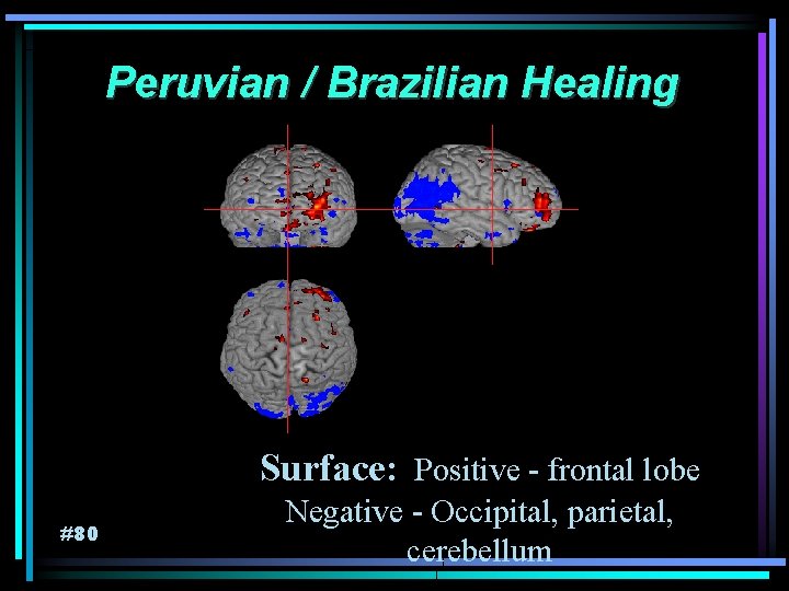 Peruvian / Brazilian Healing Surface: Positive - frontal lobe #80 Negative - Occipital, parietal,