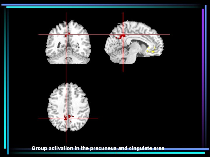 Group Activation Group activation in the precuneus and cingulate area 