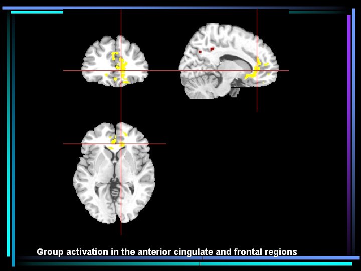 Group activation in the anterior cingulate and frontal regions 