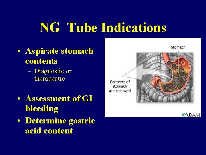 NG Tube Indications • Aspirate stomach contents – Diagnostic or therapeutic • Assessment of