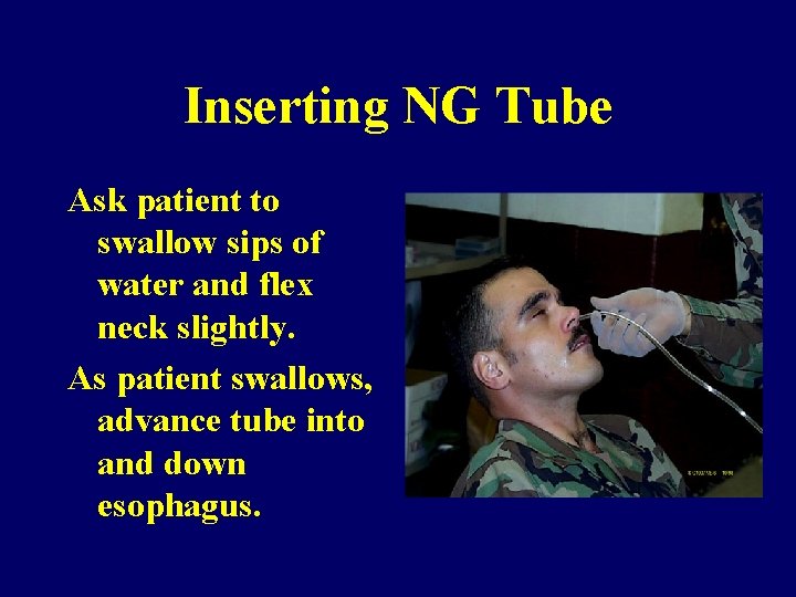 Inserting NG Tube Ask patient to swallow sips of water and flex neck slightly.