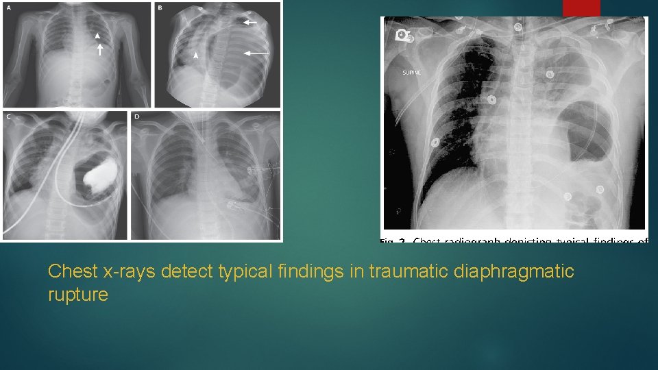 Chest x-rays detect typical findings in traumatic diaphragmatic rupture 