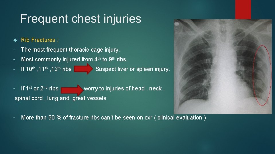 Frequent chest injuries Rib Fractures : • The most frequent thoracic cage injury. •