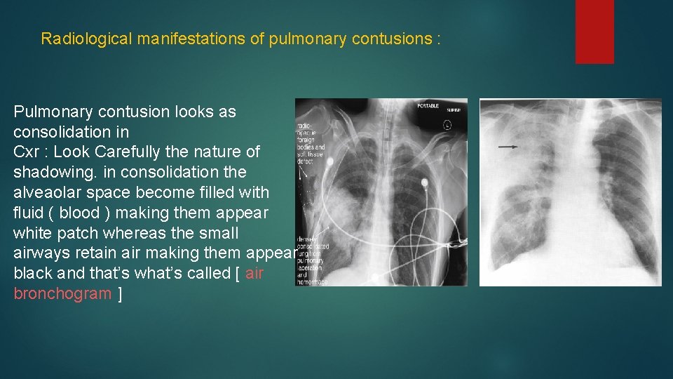 Radiological manifestations of pulmonary contusions : Pulmonary contusion looks as consolidation in Cxr :