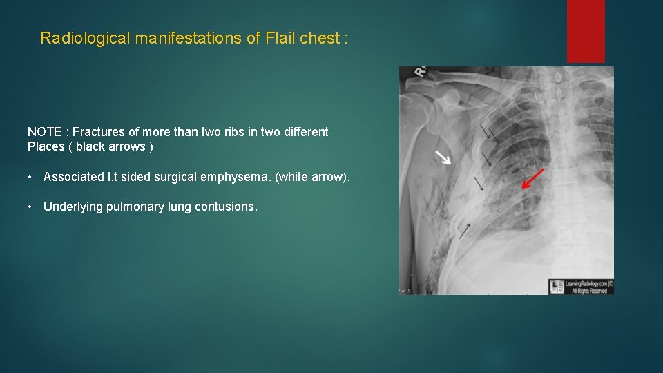 Radiological manifestations of Flail chest : NOTE ; Fractures of more than two ribs