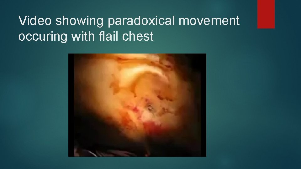 Video showing paradoxical movement occuring with flail chest 