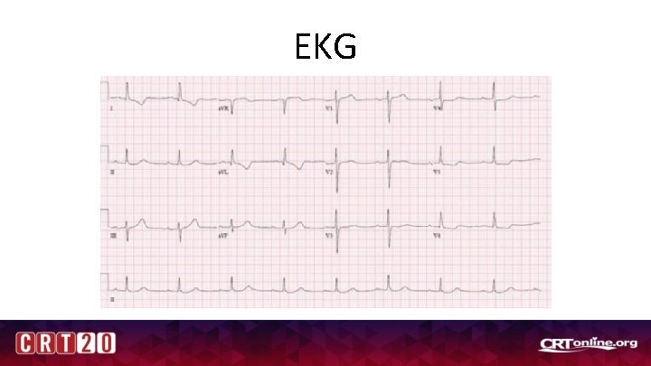 EKG 