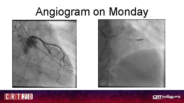 Angiogram on Monday 