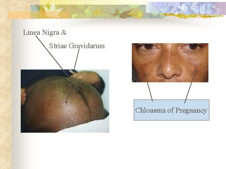 Linea Nigra & Striae Gravidarum Chloasma of Pregnancy 