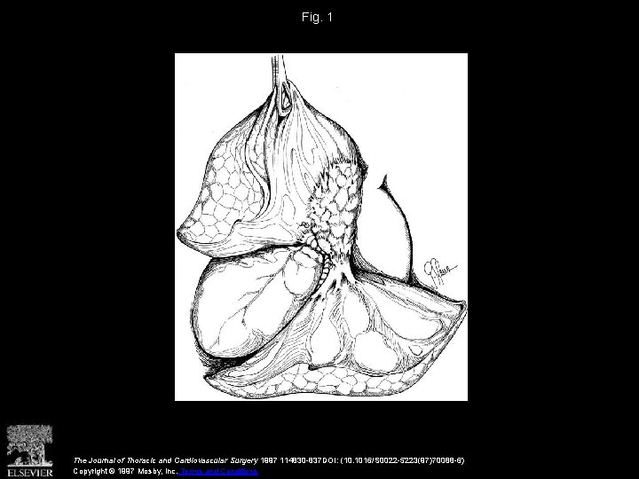 Fig. 1 The Journal of Thoracic and Cardiovascular Surgery 1997 114830 -837 DOI: (10.