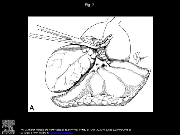 Fig. 2 The Journal of Thoracic and Cardiovascular Surgery 1997 114830 -837 DOI: (10.
