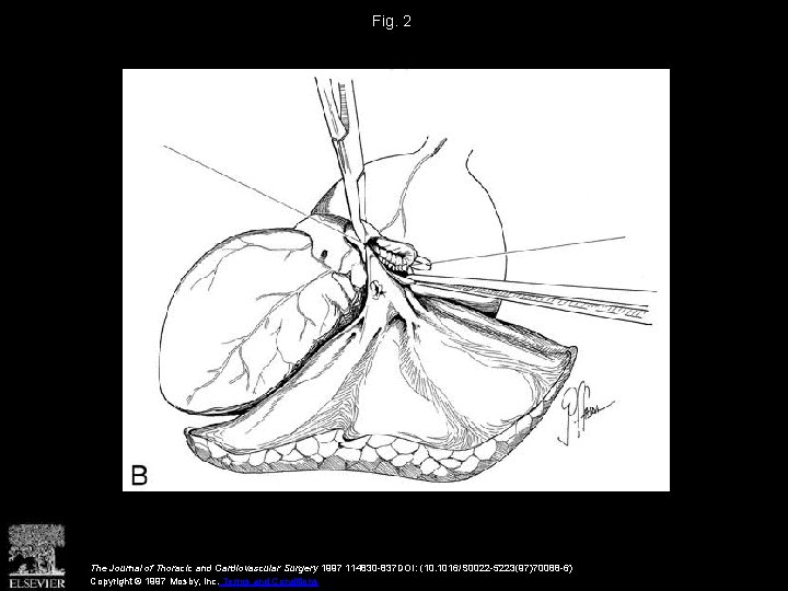 Fig. 2 The Journal of Thoracic and Cardiovascular Surgery 1997 114830 -837 DOI: (10.