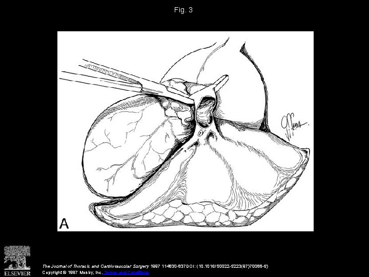 Fig. 3 The Journal of Thoracic and Cardiovascular Surgery 1997 114830 -837 DOI: (10.