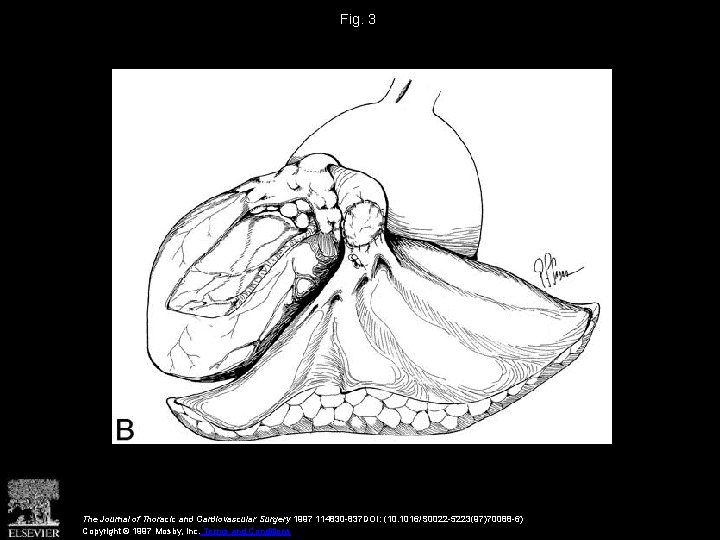 Fig. 3 The Journal of Thoracic and Cardiovascular Surgery 1997 114830 -837 DOI: (10.