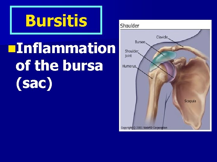 Bursitis n. Inflammation of the bursa (sac) 