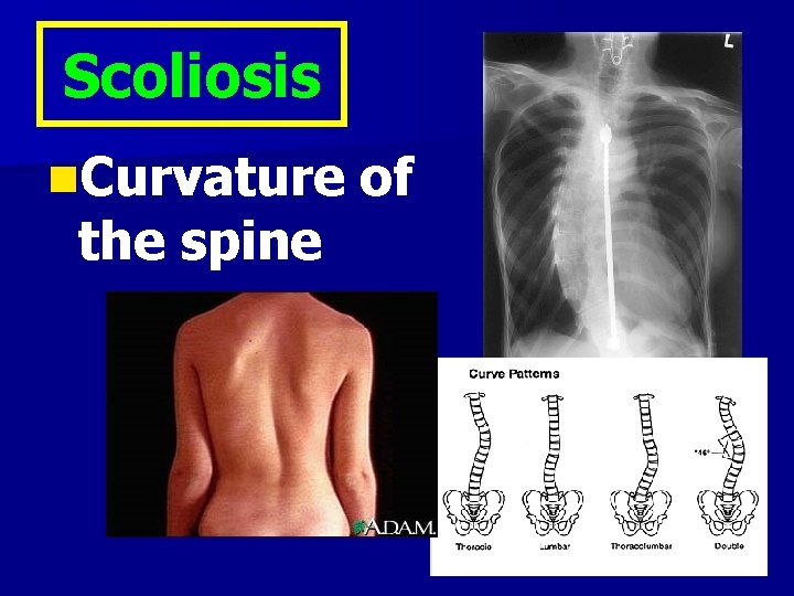 Scoliosis n. Curvature the spine of 