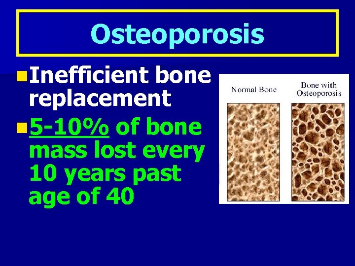 Osteoporosis n. Inefficient bone replacement n 5 -10% of bone mass lost every 10