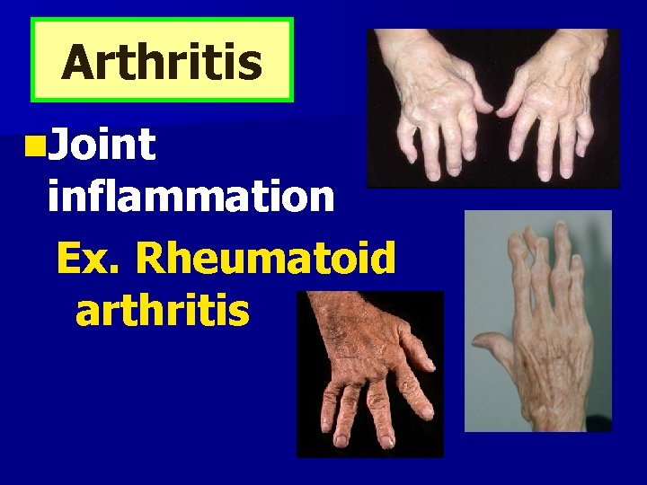 Arthritis n. Joint inflammation Ex. Rheumatoid arthritis 