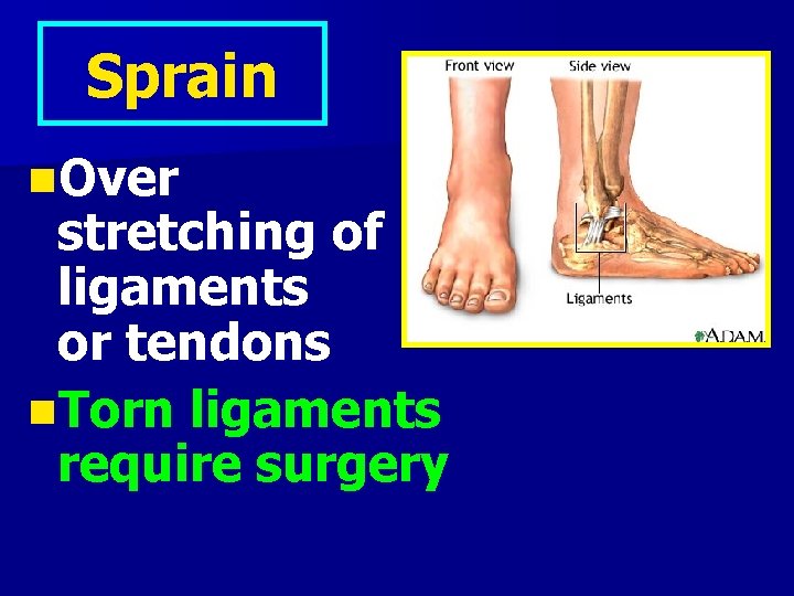 Sprain n. Over stretching of ligaments or tendons n. Torn ligaments require surgery 