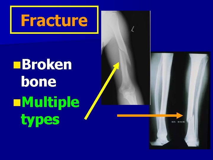 Fracture n. Broken bone n. Multiple types 