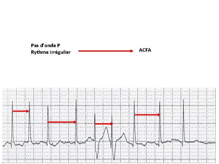 Pas d’onde P Rythme irrégulier ACFA 