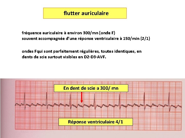 flutter auriculaire fréquence auriculaire à environ 300/mn (onde F) souvent accompagnée d’une réponse ventriculaire