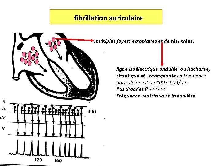 fibrillation auriculaire multiples foyers ectopiques et de réentrées. ligne isoélectrique ondulée ou hachurée, chaotique