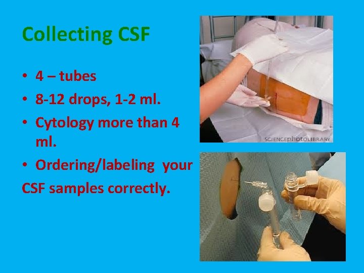 Collecting CSF • 4 – tubes • 8 -12 drops, 1 -2 ml. •