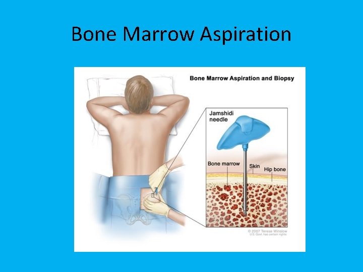 Bone Marrow Aspiration 