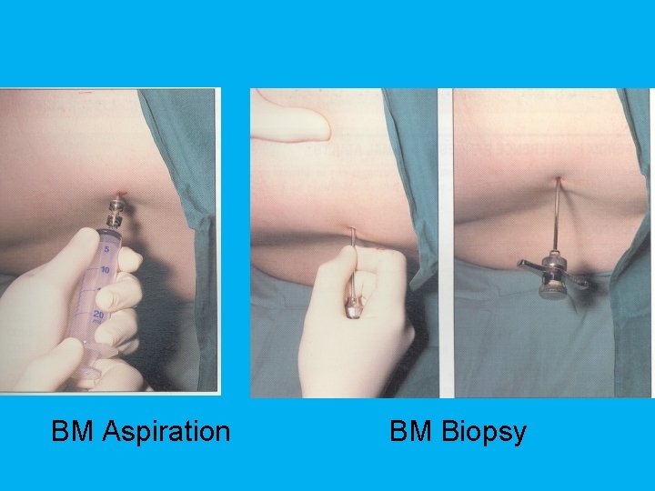 BM Aspiration BM Biopsy 