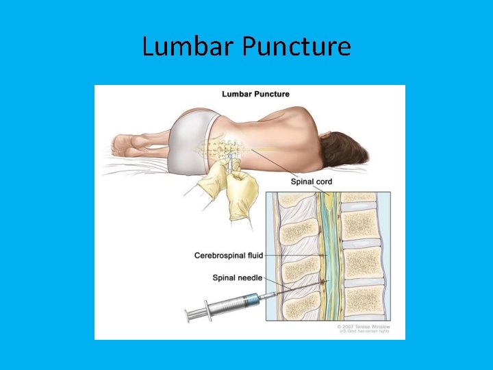 Lumbar Puncture 