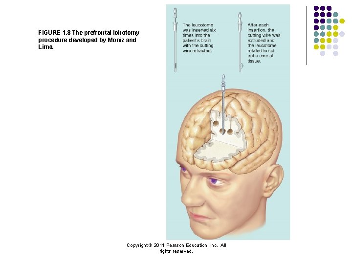 FIGURE 1. 8 The prefrontal lobotomy procedure developed by Moniz and Lima. Copyright ©