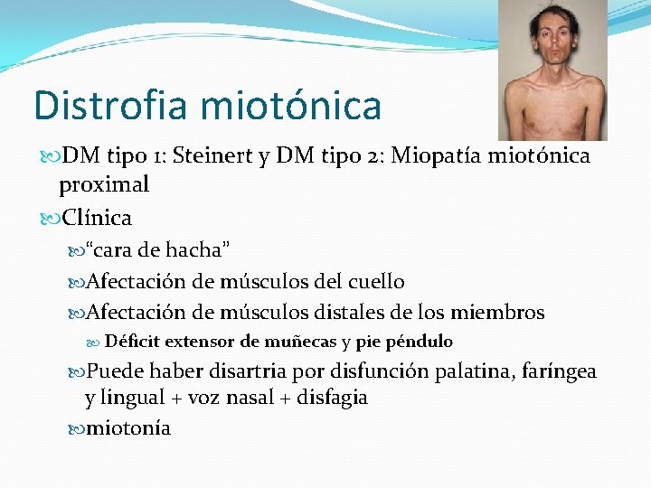 Distrofia miotónica DM tipo 1: Steinert y DM tipo 2: Miopatía miotónica proximal Clínica
