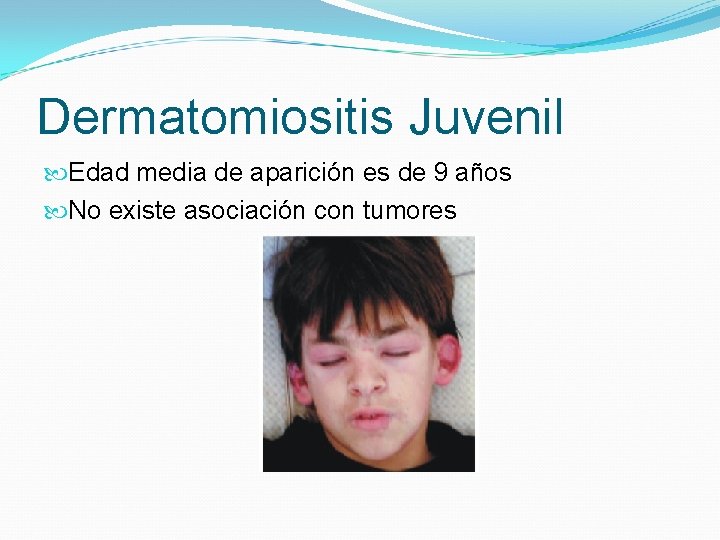 Dermatomiositis Juvenil Edad media de aparición es de 9 años No existe asociación con