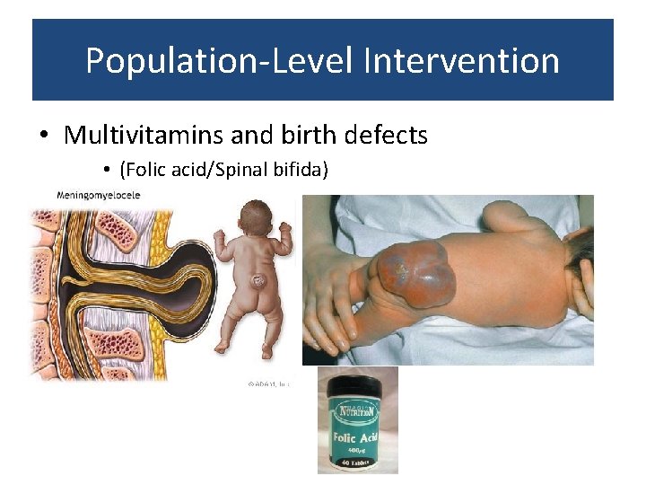 Population-Level Intervention • Multivitamins and birth defects • (Folic acid/Spinal bifida) 