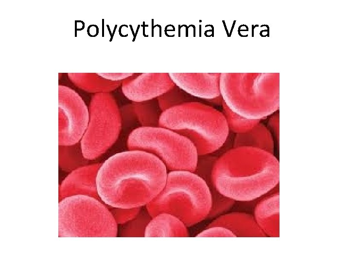 Polycythemia Vera 