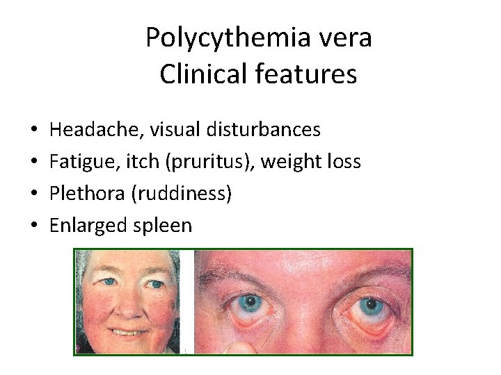 Polycythemia vera Clinical features • • Headache, visual disturbances Fatigue, itch (pruritus), weight loss