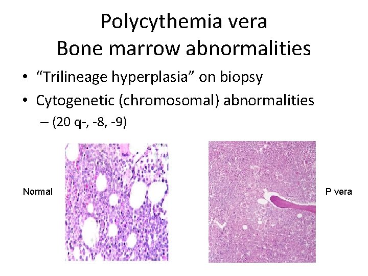 Polycythemia vera Bone marrow abnormalities • “Trilineage hyperplasia” on biopsy • Cytogenetic (chromosomal) abnormalities