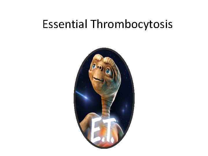 Essential Thrombocytosis 