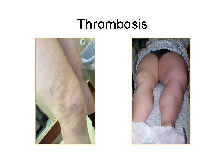 Thrombosis 