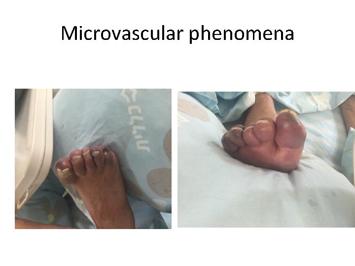 Microvascular phenomena 