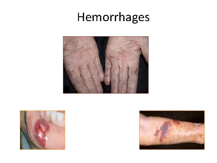 Hemorrhages 